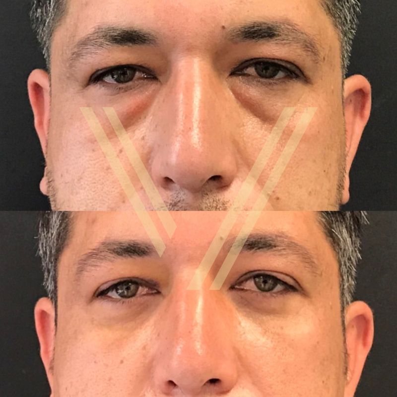 Turkey blepharoplasty example from Vantage Clinic case 4