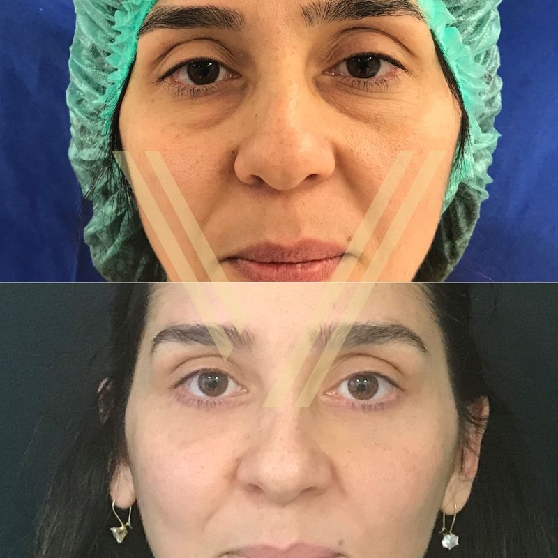 Turkey blepharoplasty example from Vantage Clinic case 5