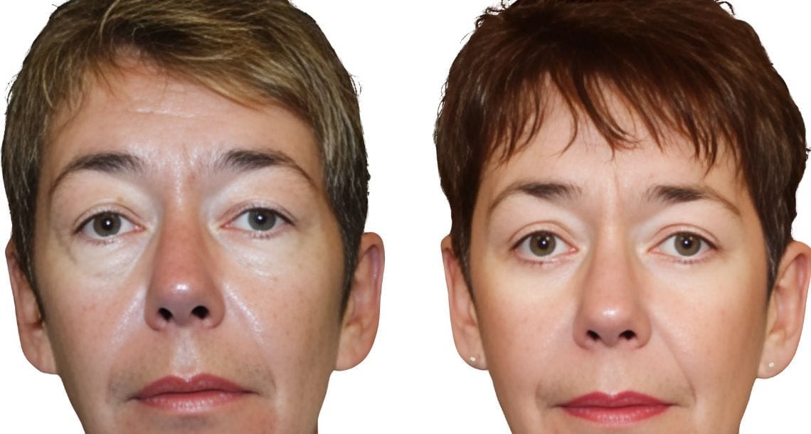 Turkey blepharoplasty example from Vivid Clinic Istanbul case 2