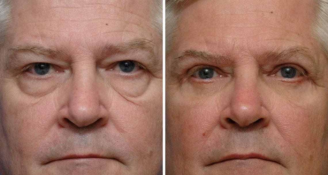Turkey blepharoplasty example from Vivid Clinic Istanbul case 3