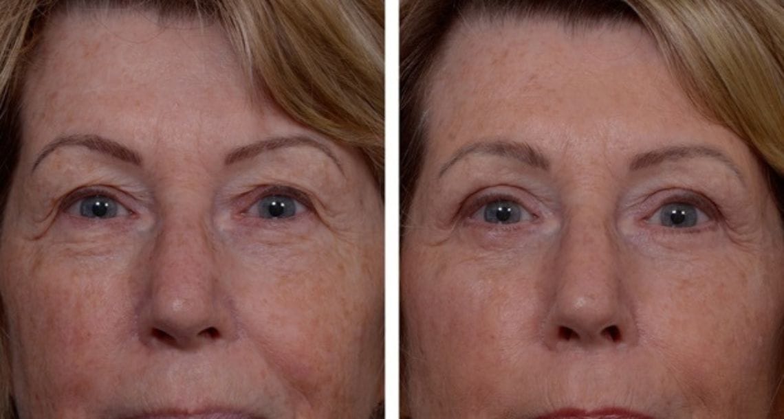 Turkey blepharoplasty example from Vivid Clinic Istanbul case 4