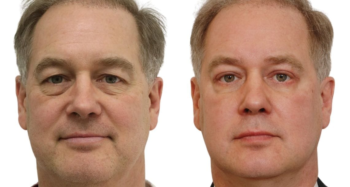 Turkey blepharoplasty example from Vivid Clinic Istanbul case 5