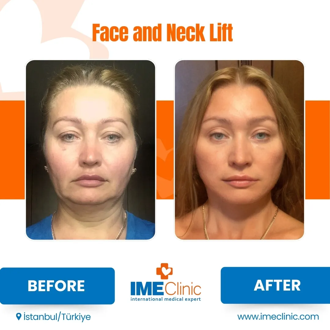 Before and after facelift comparison, Atacan Emre Kocman, source-gallery image 1