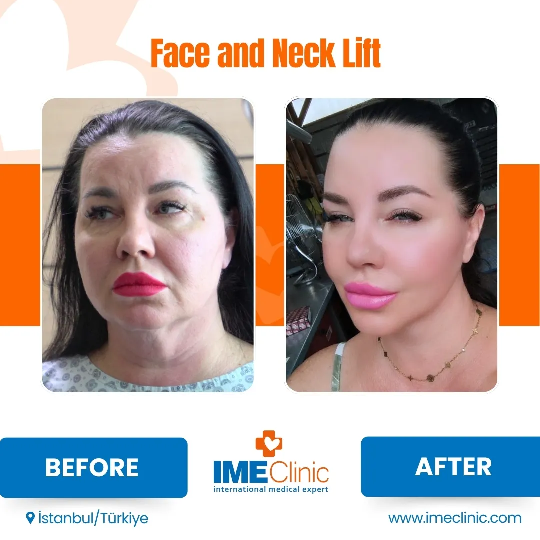 Before and after facelift comparison, Atacan Emre Kocman, source-gallery image 2