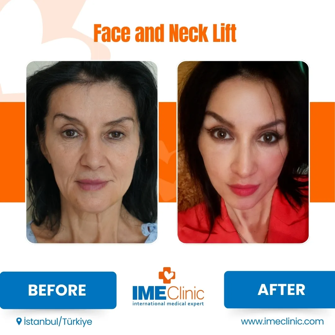 Before and after facelift comparison, Atacan Emre Kocman, source-gallery image 3