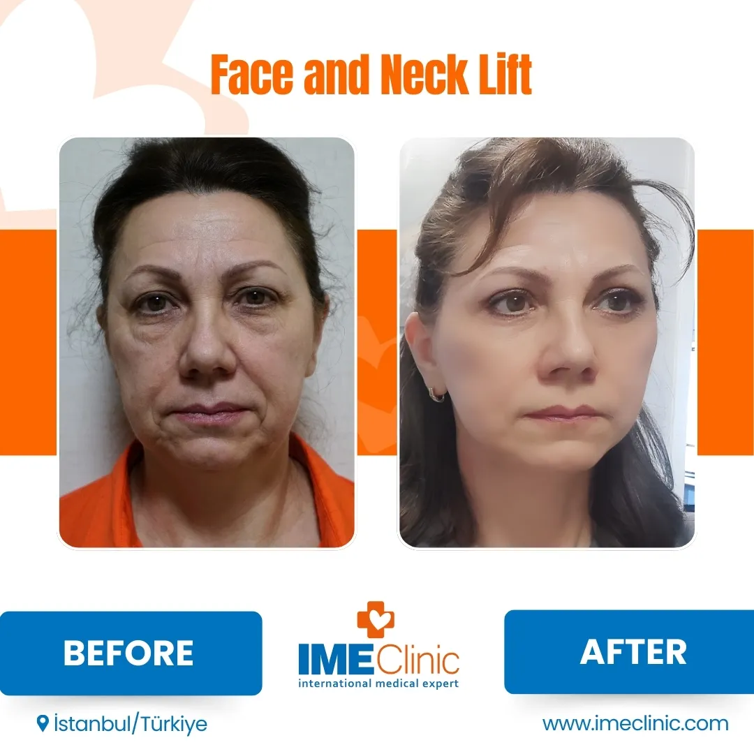 Before and after facelift comparison, Atacan Emre Kocman, source-gallery image 4