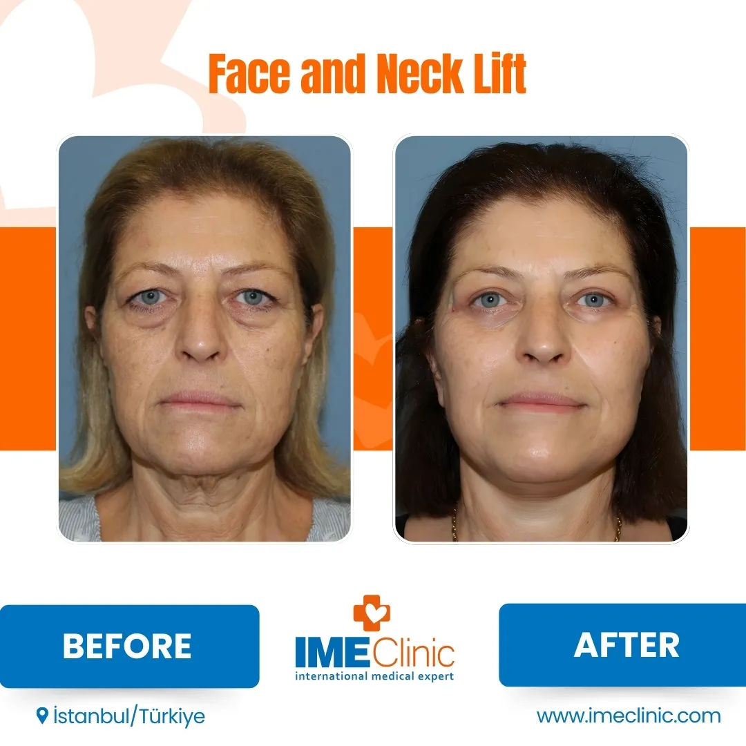 Before and after facelift comparison, Atacan Emre Kocman, source-gallery image 5