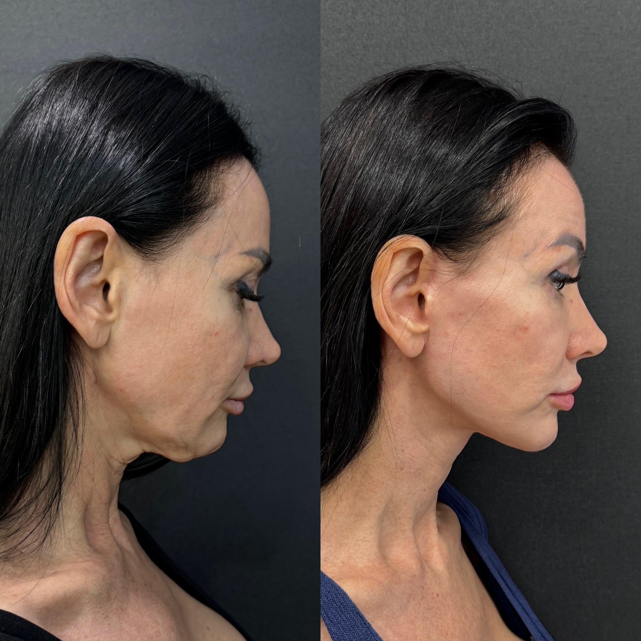 Before and after facelift comparison, Cem Berkay Sinaci, source-gallery image 3