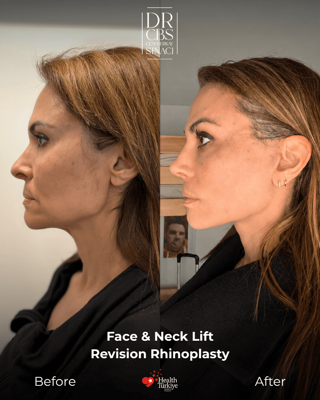 Before and after facelift comparison, Cem Berkay Sinaci, source-gallery image 5