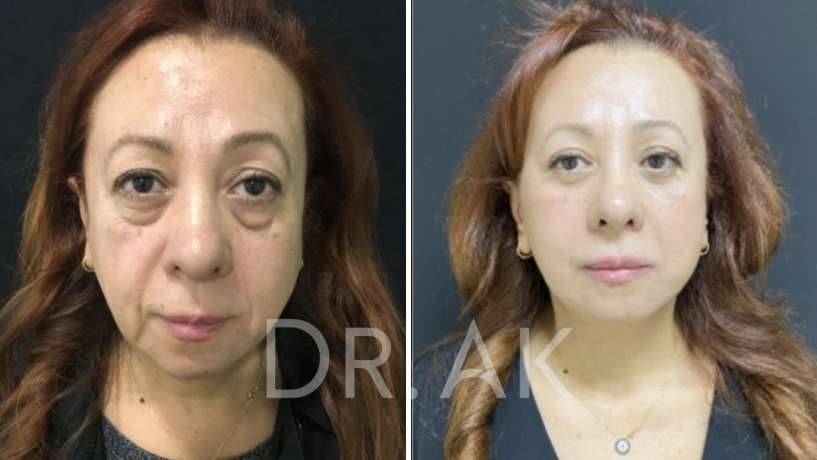 Before and after facelift comparison, Erman Ak, source-gallery image 1