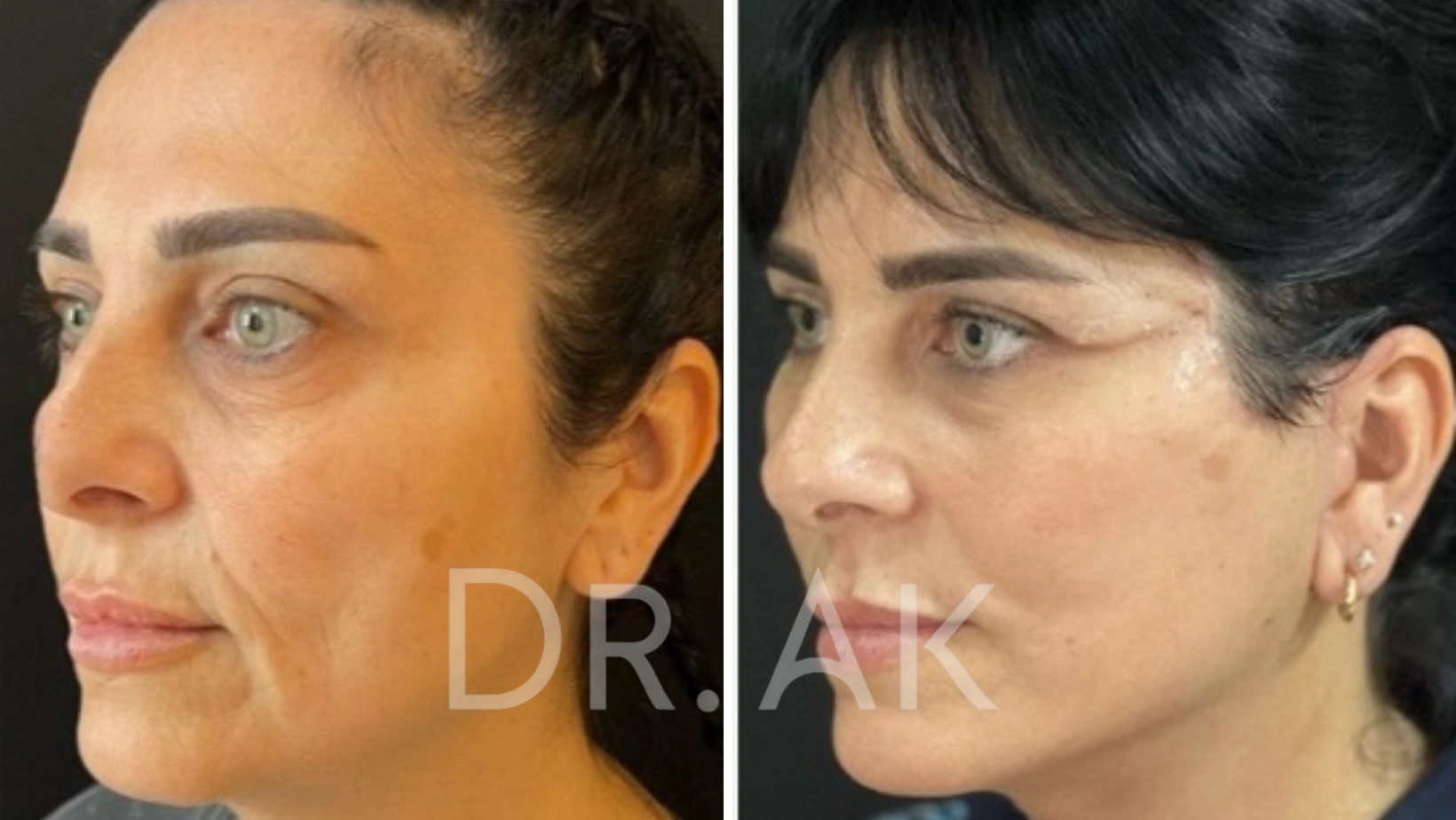 Before and after facelift comparison, Erman Ak, source-gallery image 2