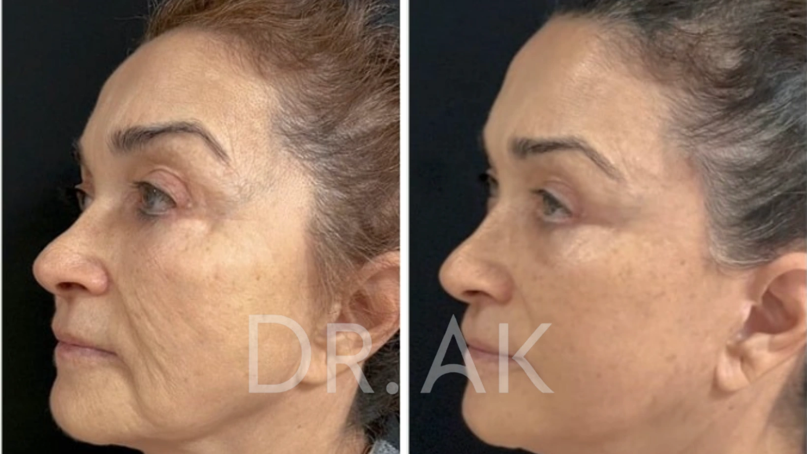 Before and after facelift comparison, Erman Ak, source-gallery image 3