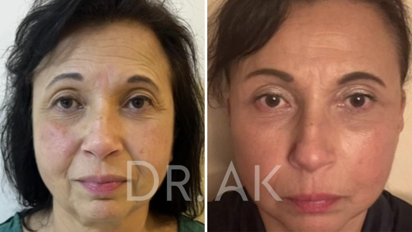 Before and after facelift comparison, Erman Ak, source-gallery image 4