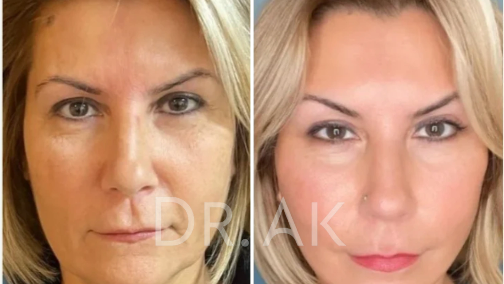 Before and after facelift comparison, Erman Ak, source-gallery image 5