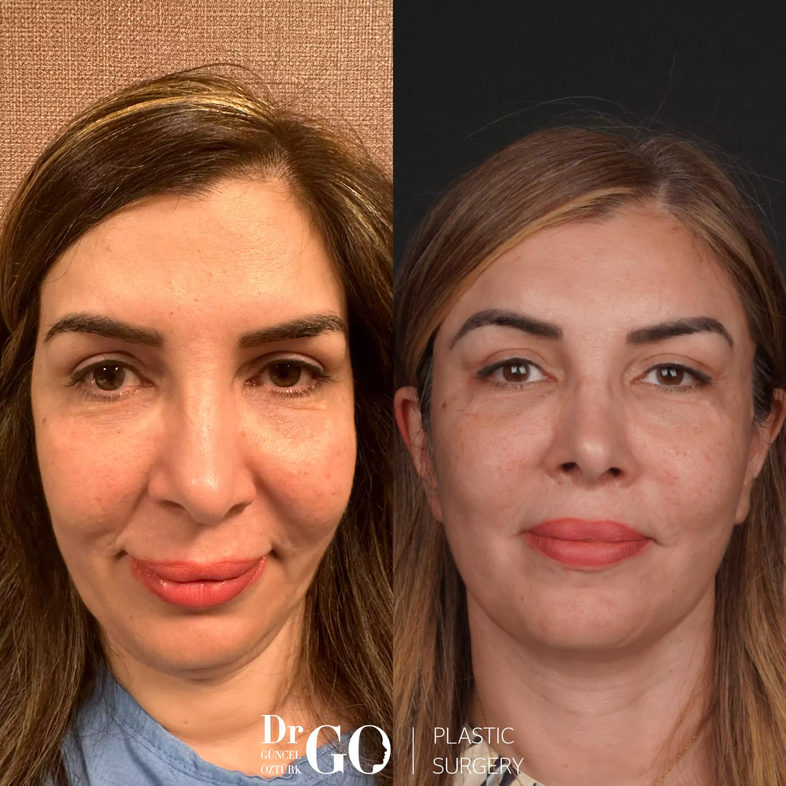 Before and after facelift comparison, Guncel Ozturk, source-gallery image 1