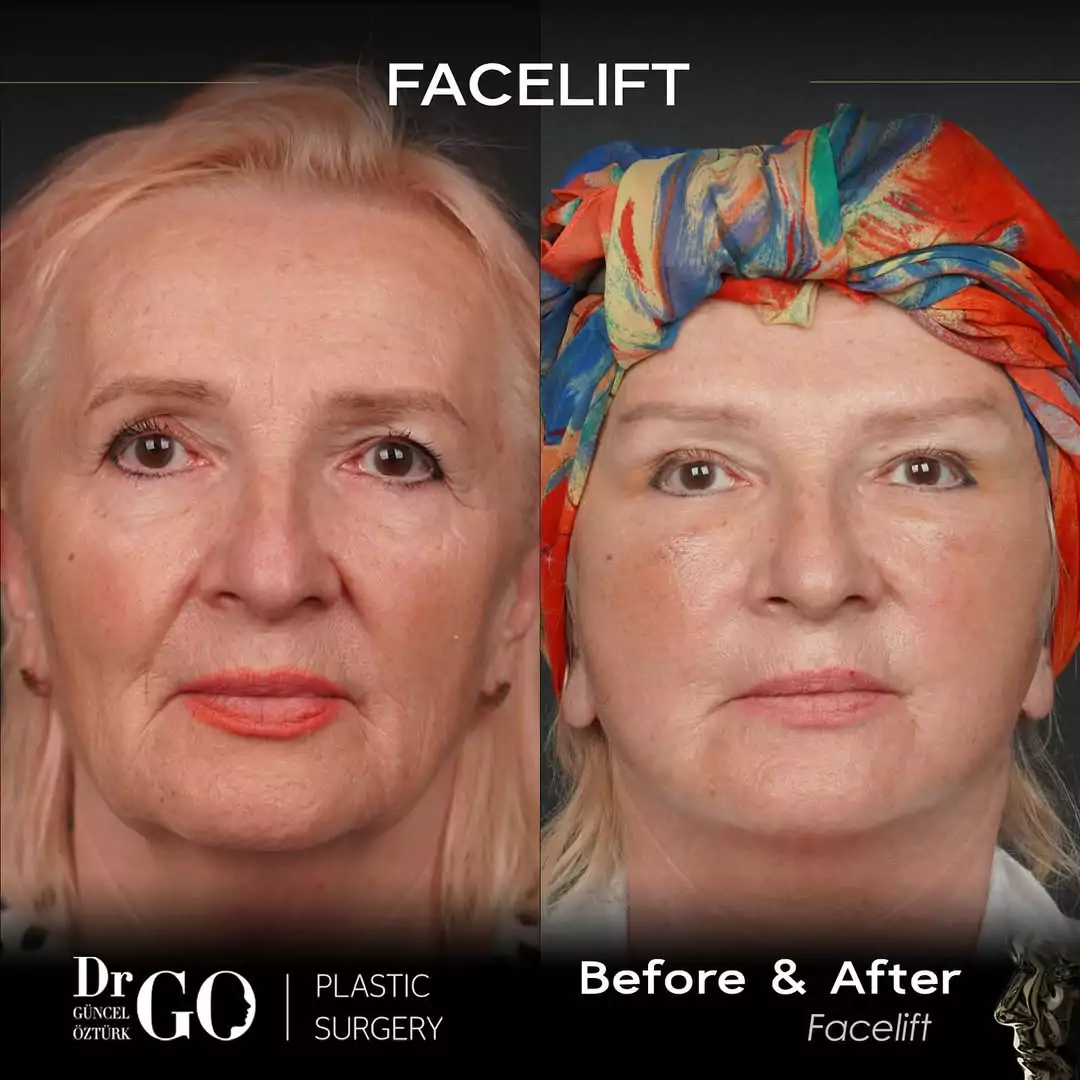 Before and after facelift comparison, Guncel Ozturk, source-gallery image 2