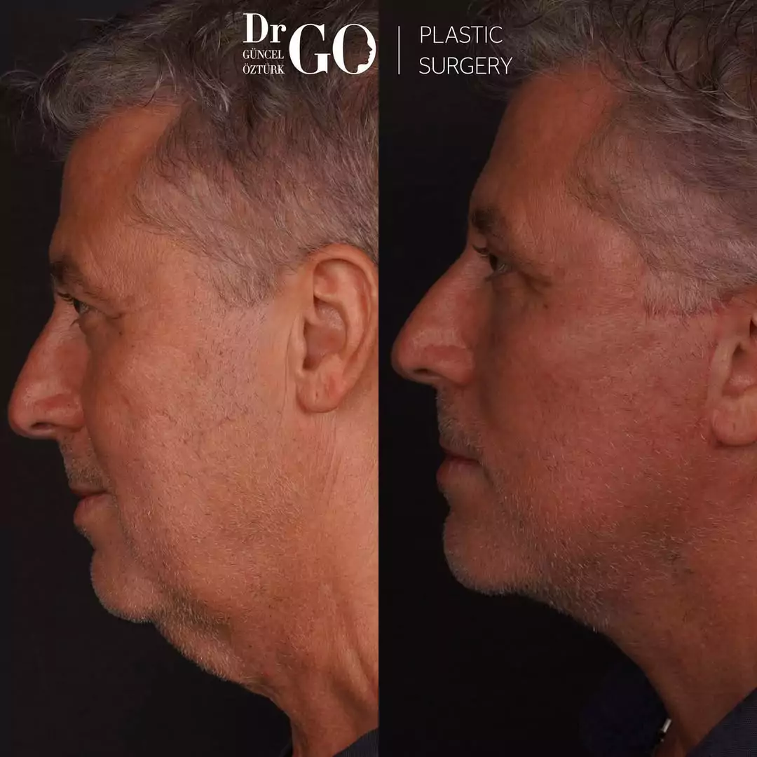 Before and after facelift comparison, Guncel Ozturk, source-gallery image 3