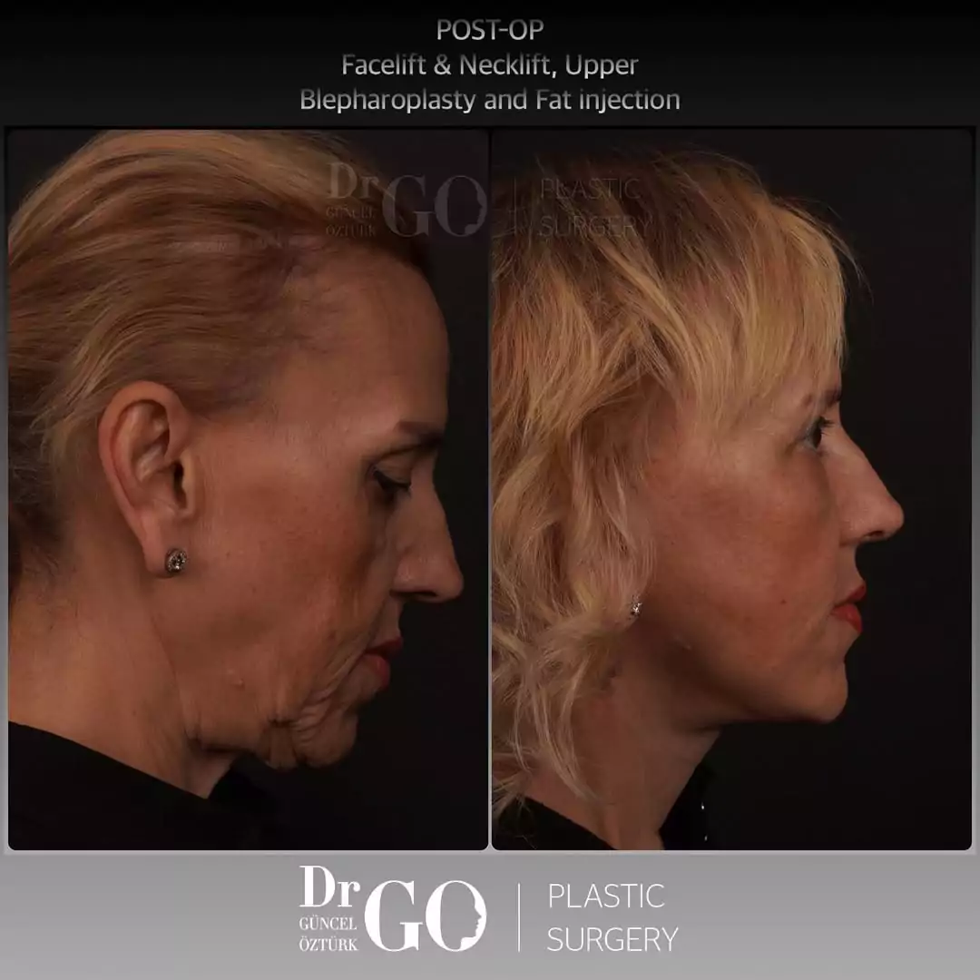Before and after facelift comparison, Guncel Ozturk, source-gallery image 4