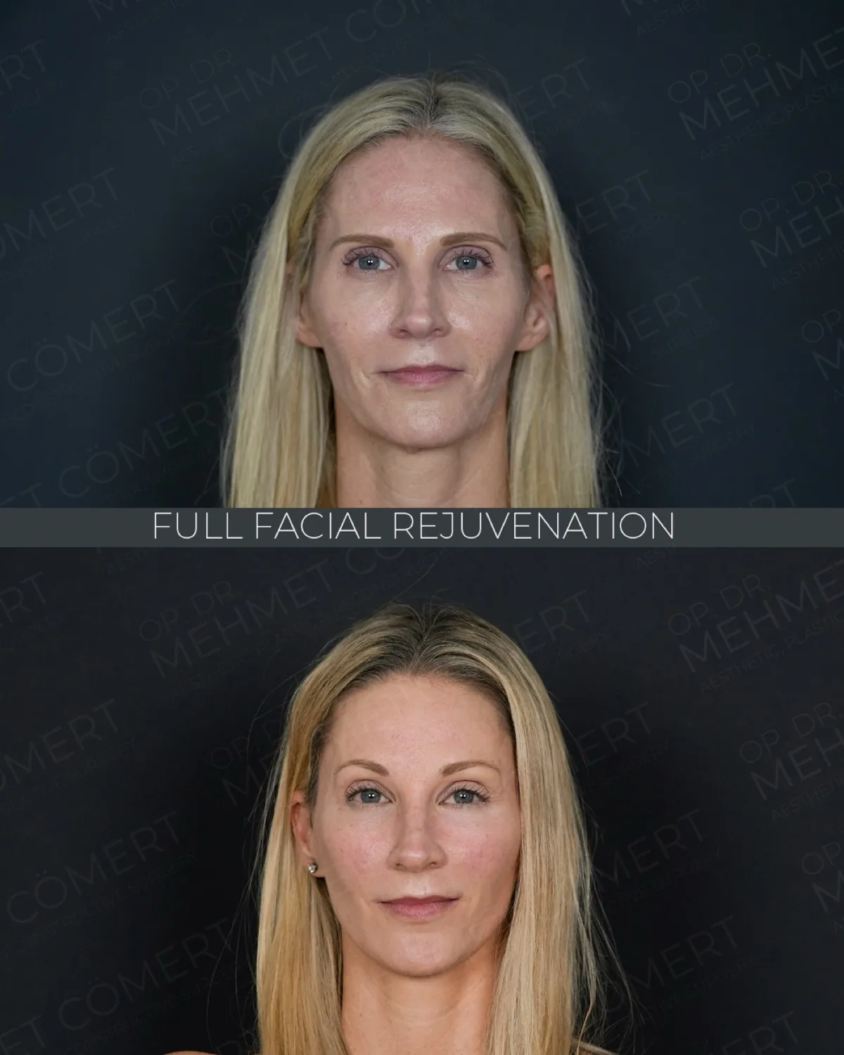 Before and after facelift comparison, Mehmet Comert, source-gallery image 1