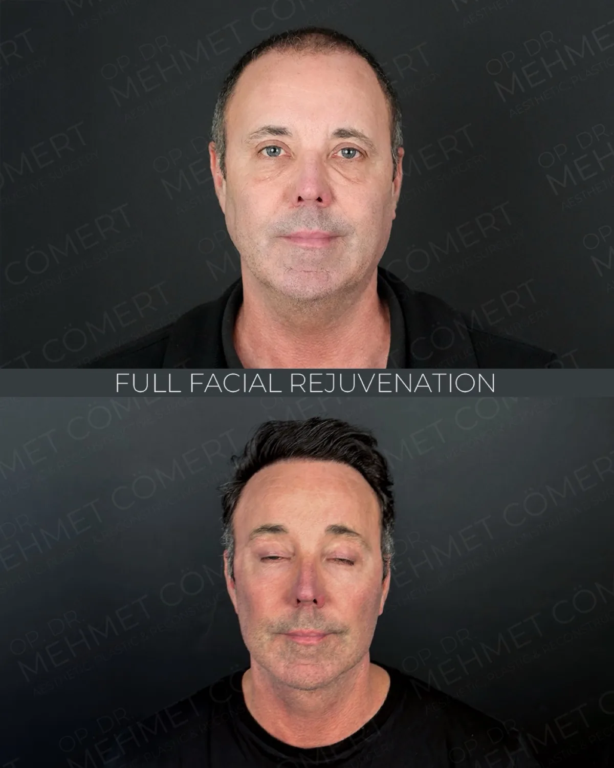 Before and after facelift comparison, Mehmet Comert, source-gallery image 3