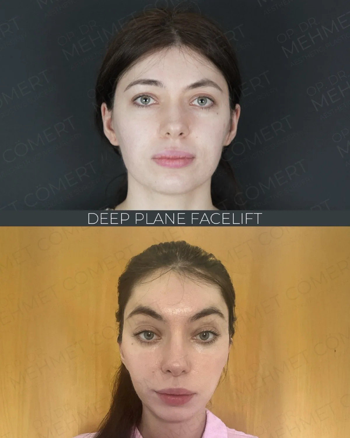 Before and after facelift comparison, Mehmet Comert, source-gallery image 5