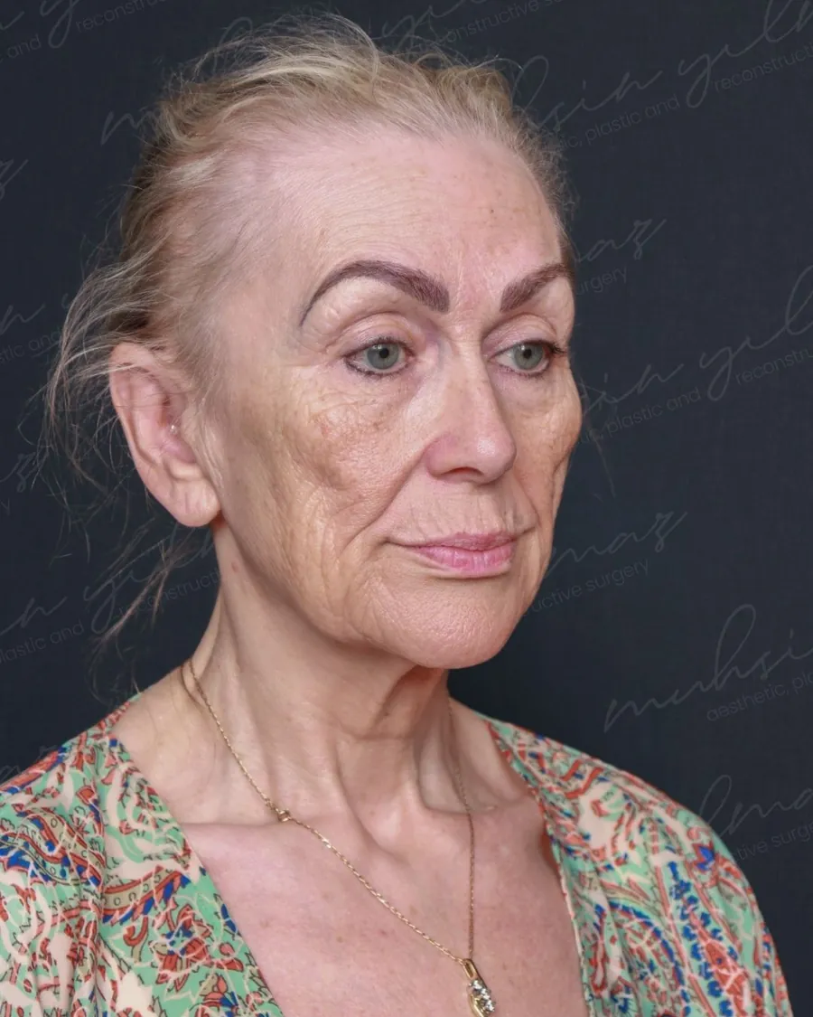 Muhsin Yilmaz facelift case 1, before photograph from the credited source gallery