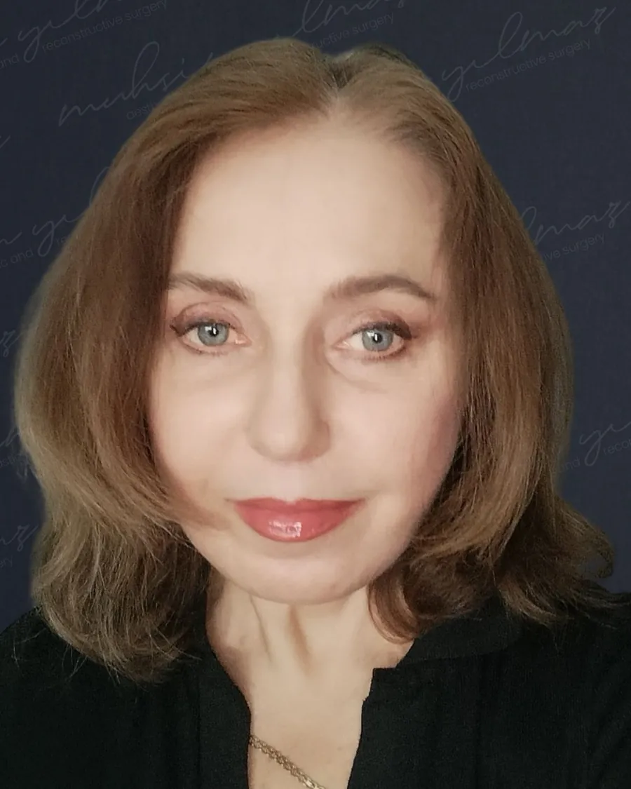 Muhsin Yilmaz facelift case 4, after photograph from the credited source gallery
