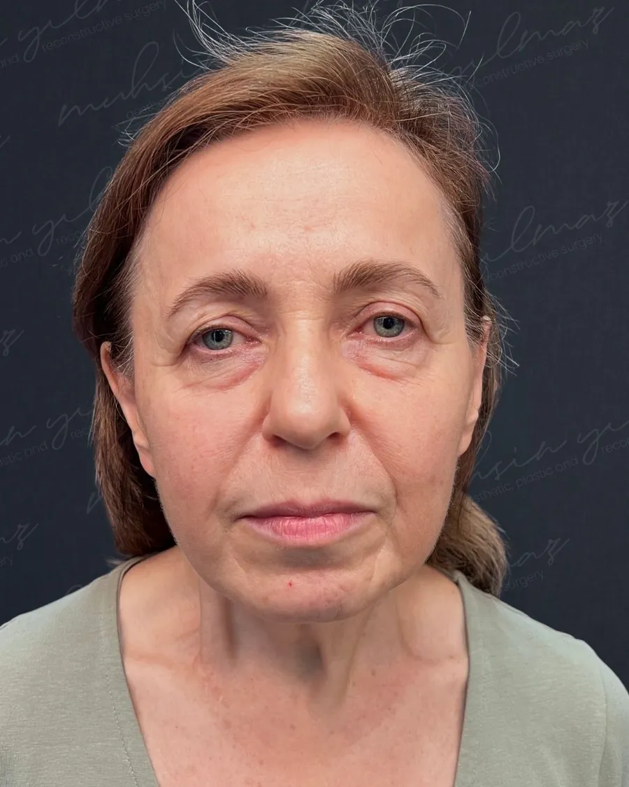 Muhsin Yilmaz facelift case 4, before photograph from the credited source gallery