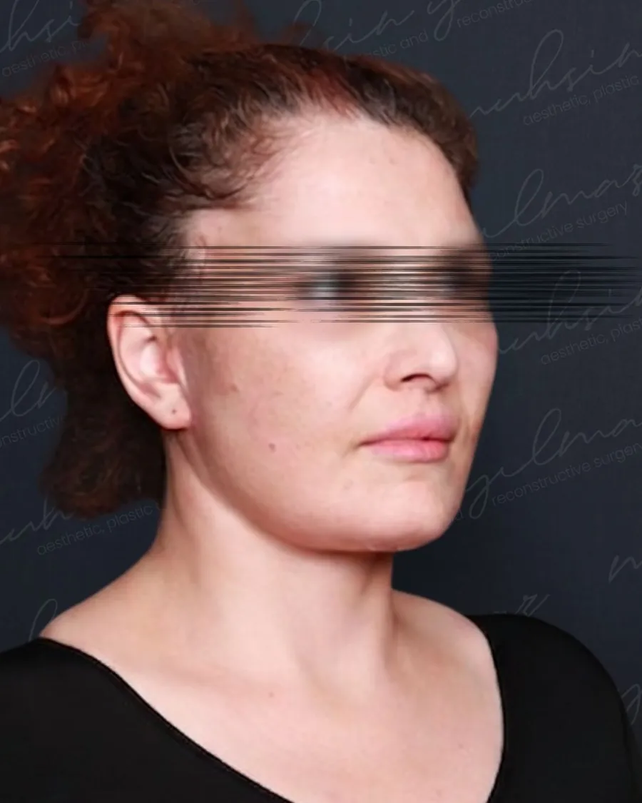 Muhsin Yilmaz facelift case 5, after photograph from the credited source gallery