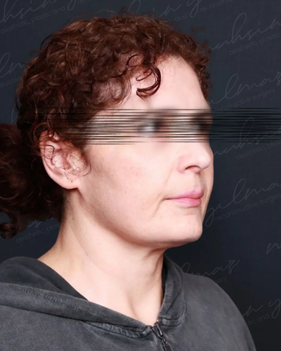 Muhsin Yilmaz facelift case 5, before photograph from the credited source gallery