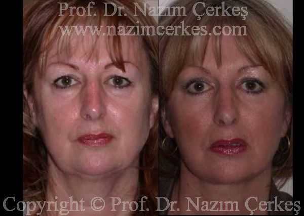 Before and after facelift comparison, Nazim Cerkes, source-gallery image 1