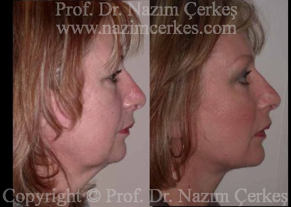 Before and after facelift comparison, Nazim Cerkes, source-gallery image 2