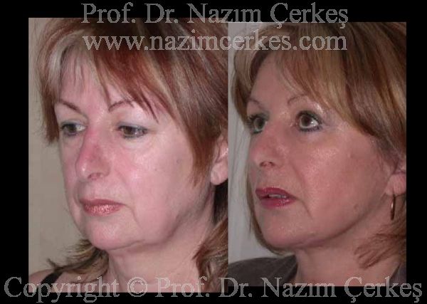 Before and after facelift comparison, Nazim Cerkes, source-gallery image 3