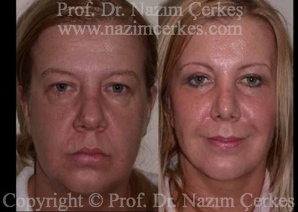 Before and after facelift comparison, Nazim Cerkes, source-gallery image 4