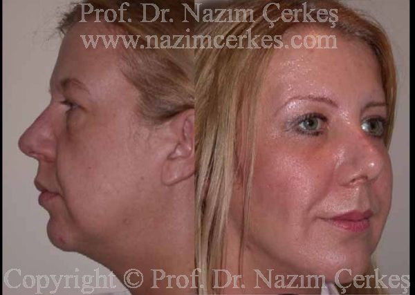 Before and after facelift comparison, Nazim Cerkes, source-gallery image 5