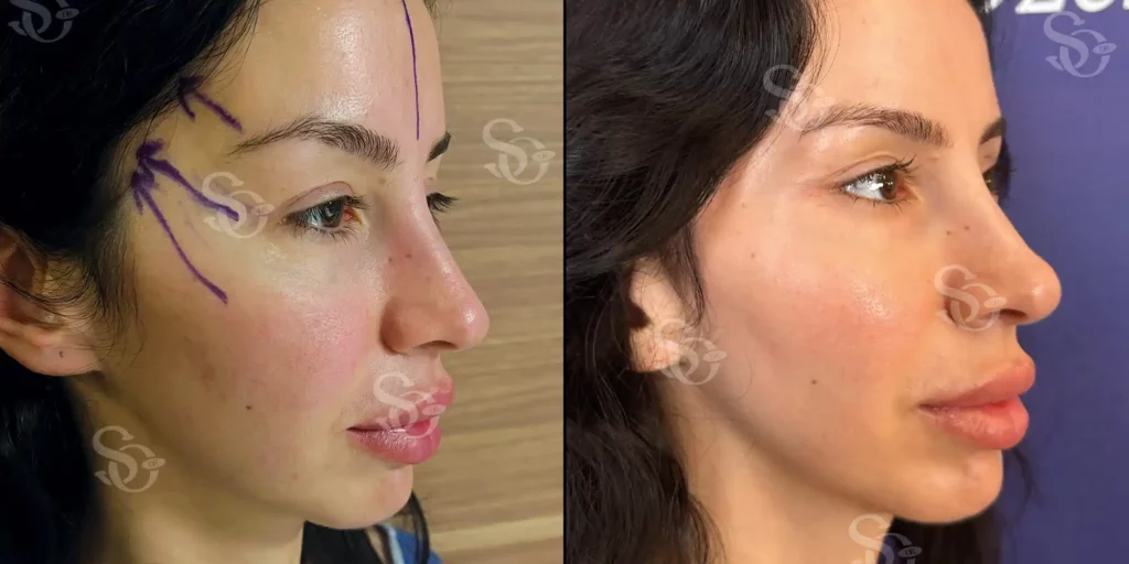 Before and after facelift comparison, Suleyman Ozer, source-gallery image 1