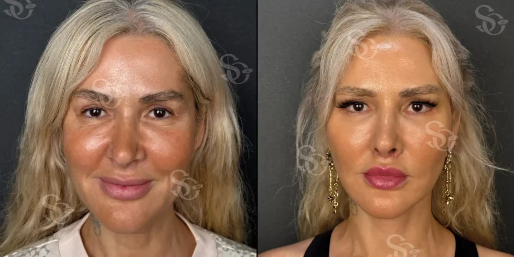 Before and after facelift comparison, Suleyman Ozer, source-gallery image 2