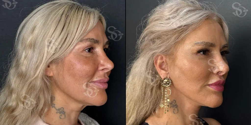 Before and after facelift comparison, Suleyman Ozer, source-gallery image 3