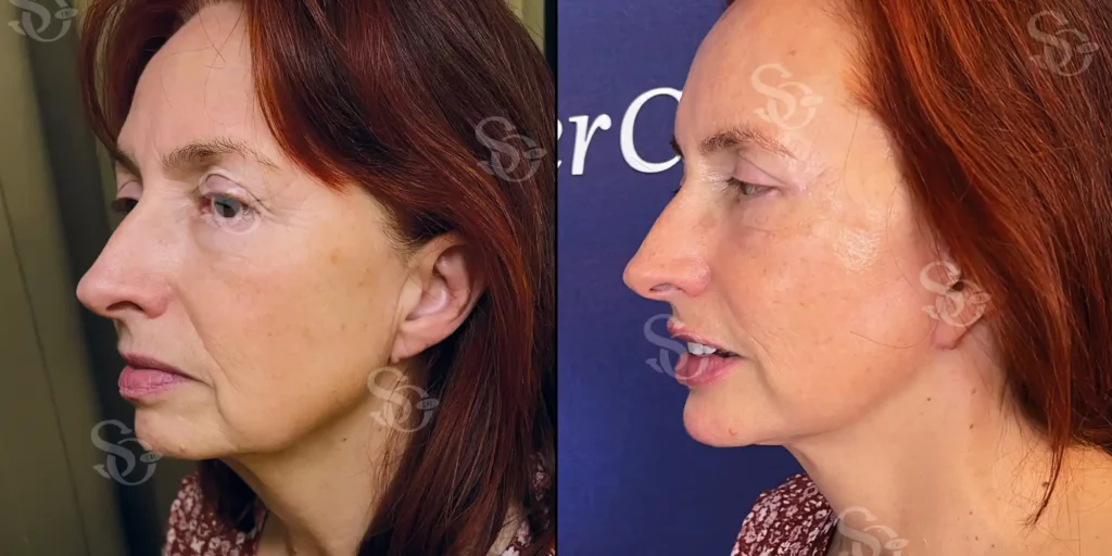 Before and after facelift comparison, Suleyman Ozer, source-gallery image 4