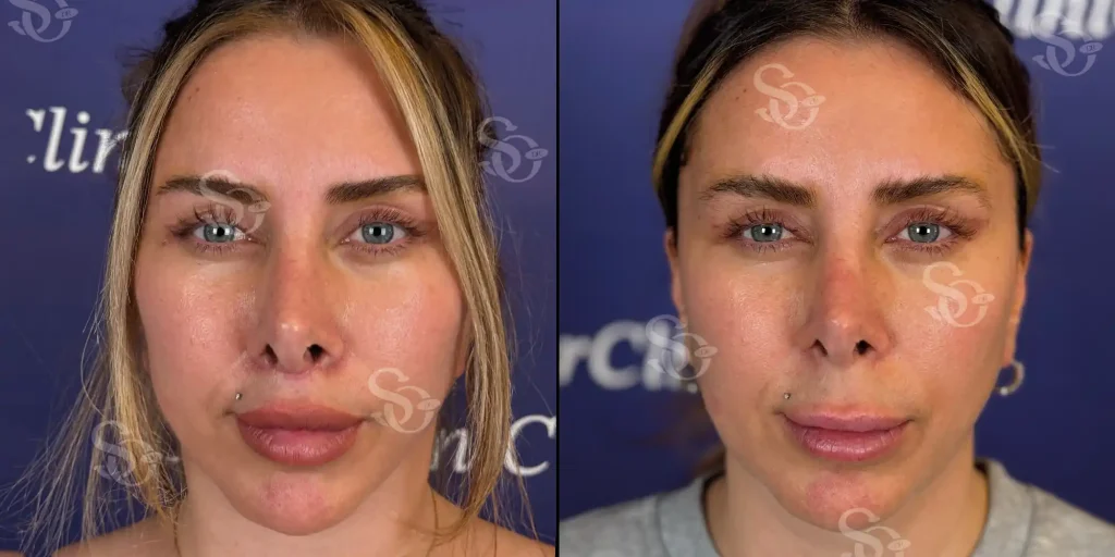 Before and after facelift comparison, Suleyman Ozer, source-gallery image 5