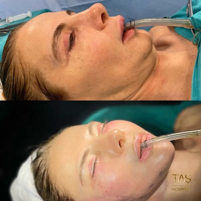 Before and after facelift comparison, Suleyman Tas, source-gallery image 1