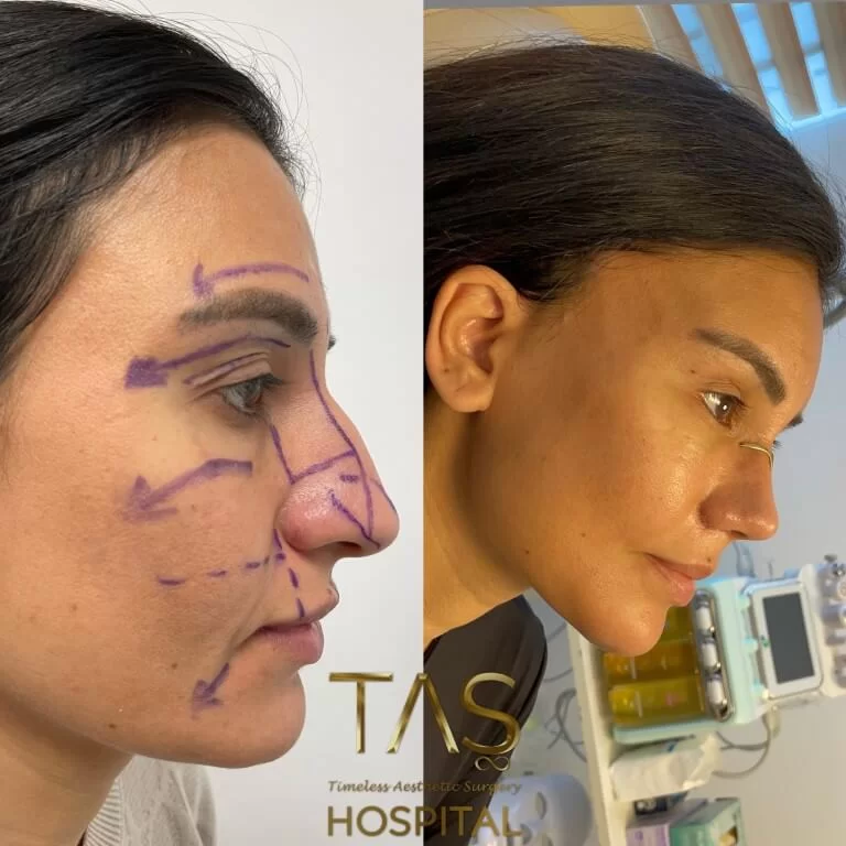 Before and after facelift comparison, Suleyman Tas, source-gallery image 2