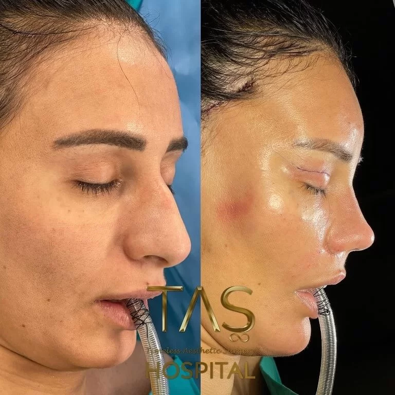 Before and after facelift comparison, Suleyman Tas, source-gallery image 3