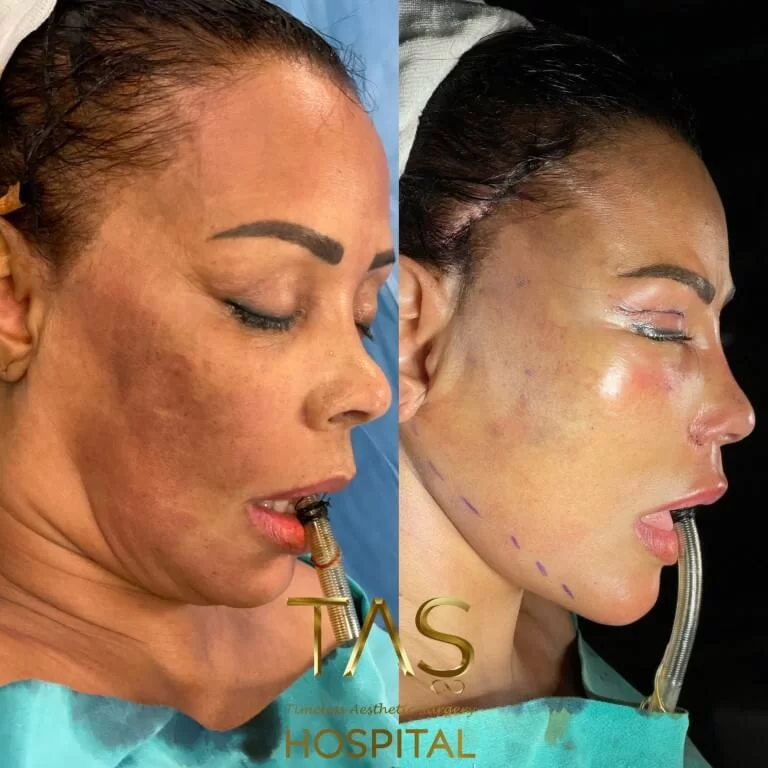 Before and after facelift comparison, Suleyman Tas, source-gallery image 4