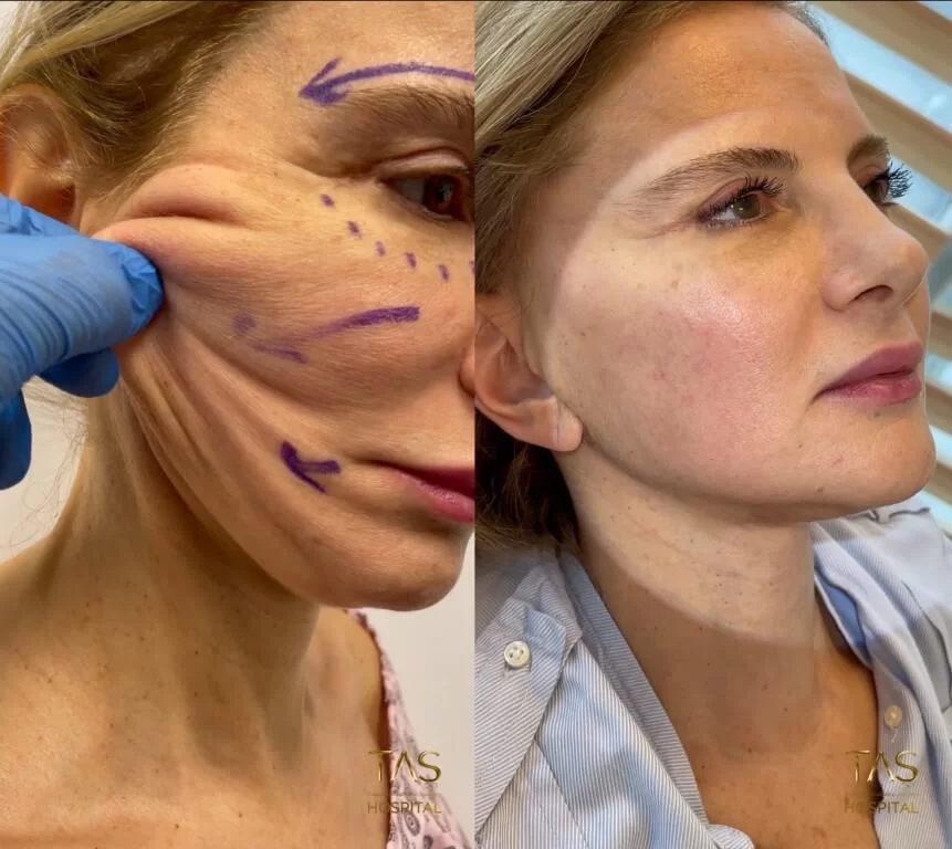 Before and after facelift comparison, Suleyman Tas, source-gallery image 5