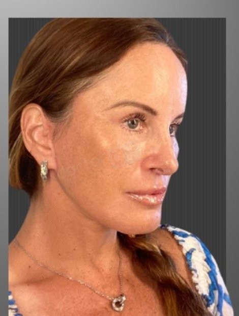 Umut Zereyak facelift case 1, after photograph from the credited source gallery
