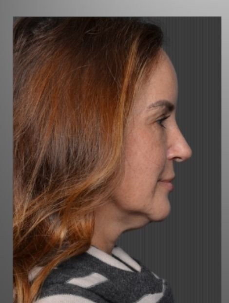 Umut Zereyak facelift case 1, before photograph from the credited source gallery