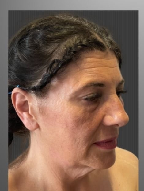 Umut Zereyak facelift case 2, before photograph from the credited source gallery