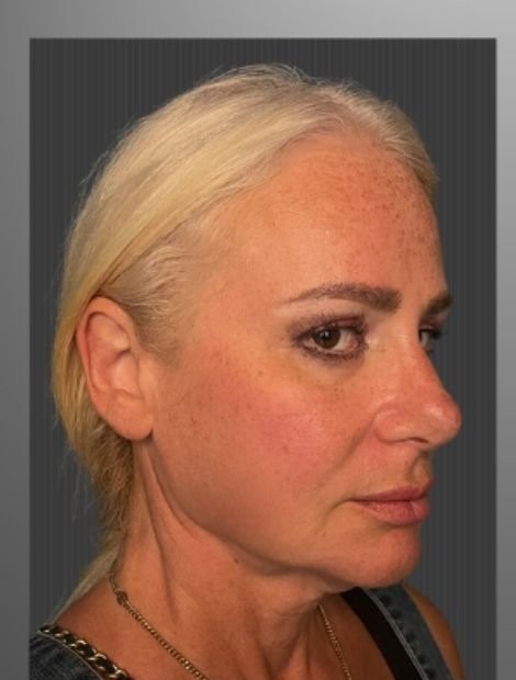Umut Zereyak facelift case 3, before photograph from the credited source gallery