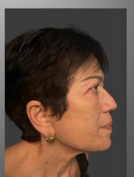 Umut Zereyak facelift case 4, after photograph from the credited source gallery